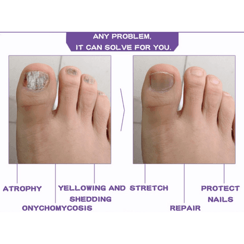 Nail Serum for Long healthy & fungus free nails