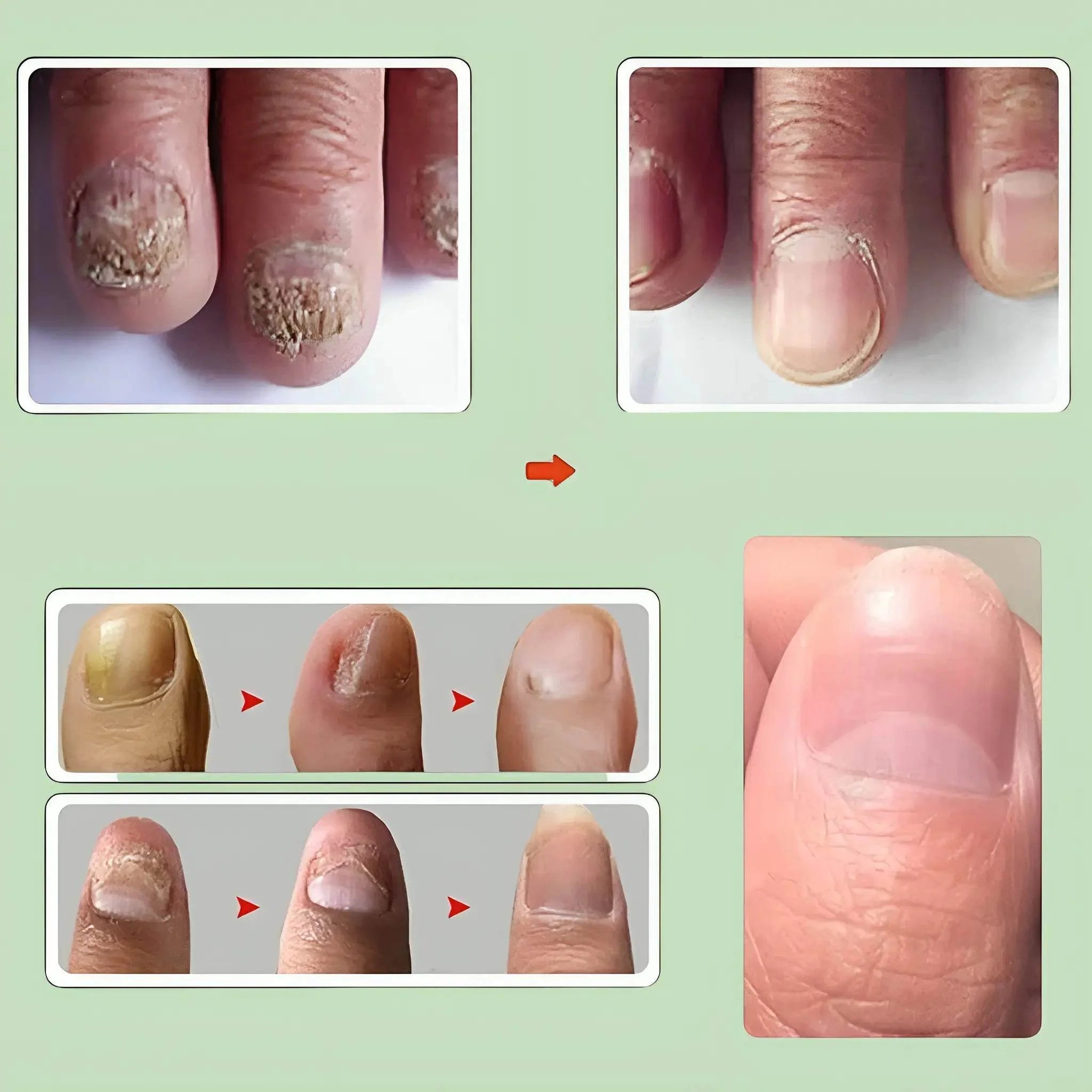 Nail Serum for Long healthy & fungus free nails